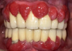 Advanced Periodontal & Gum Therapy before treatment