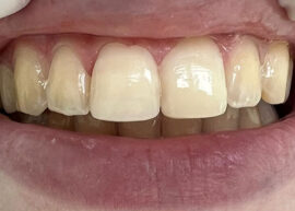 Aesthetic Composite Reconstruction after treatment