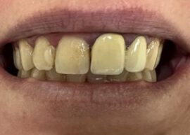 Premium Multi-Layer Zirconia Crowns before treatment
