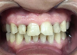 Full-Arch Immediate Restoration (Teeth-in-a-Day) before treatment