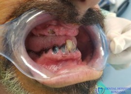Full-Mouth Surgical Rehabilitation before treatment