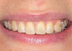 Advanced Clear Aligner Therapy before treatment