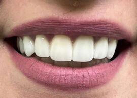 Premium Multi-Layer Zirconia Crowns after treatment
