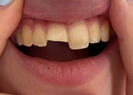 Aesthetic Composite Reconstruction before treatment